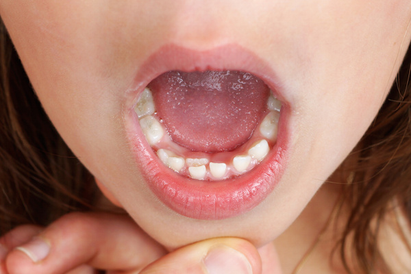 Double rows of teeth?