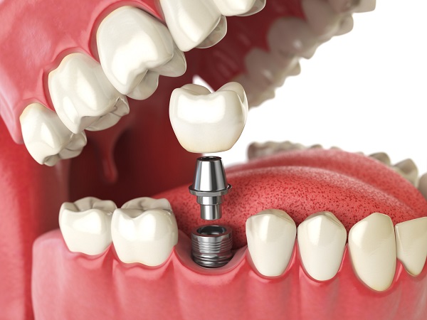 Deconstructing Dental Implants