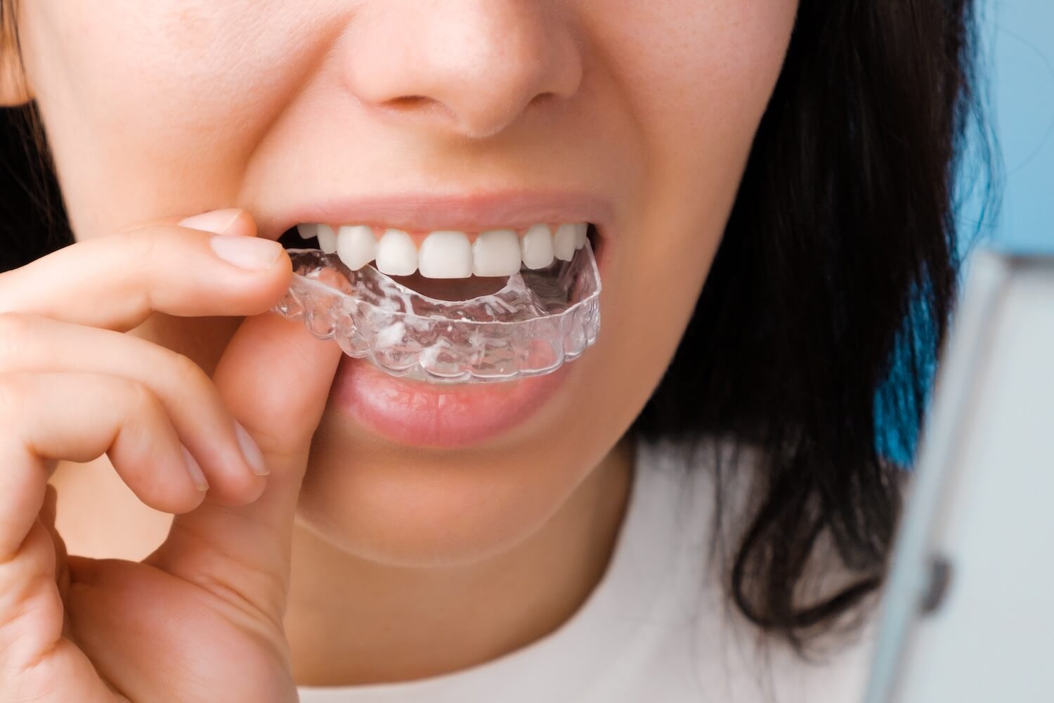 What Are All of The Benefits of Clear Braces Like Invisalign