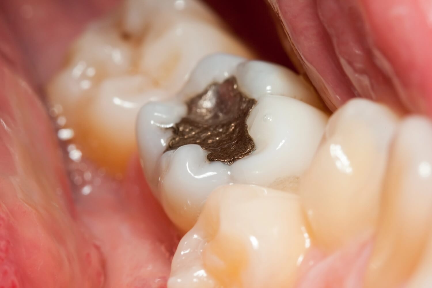 mercury free dentistry near me