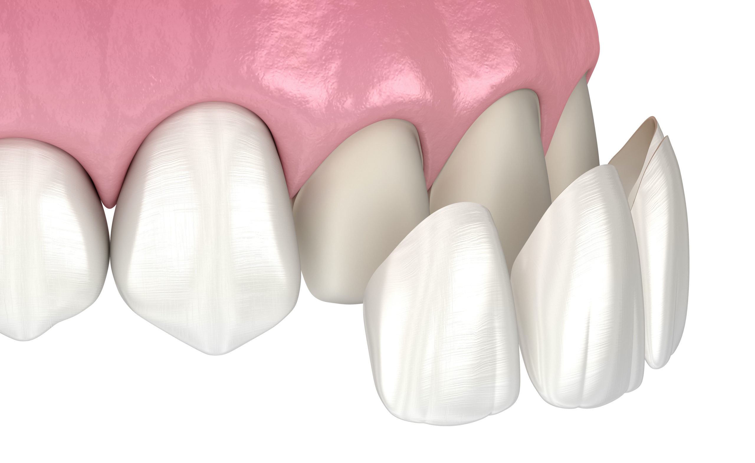 cubic zirconia dental crown