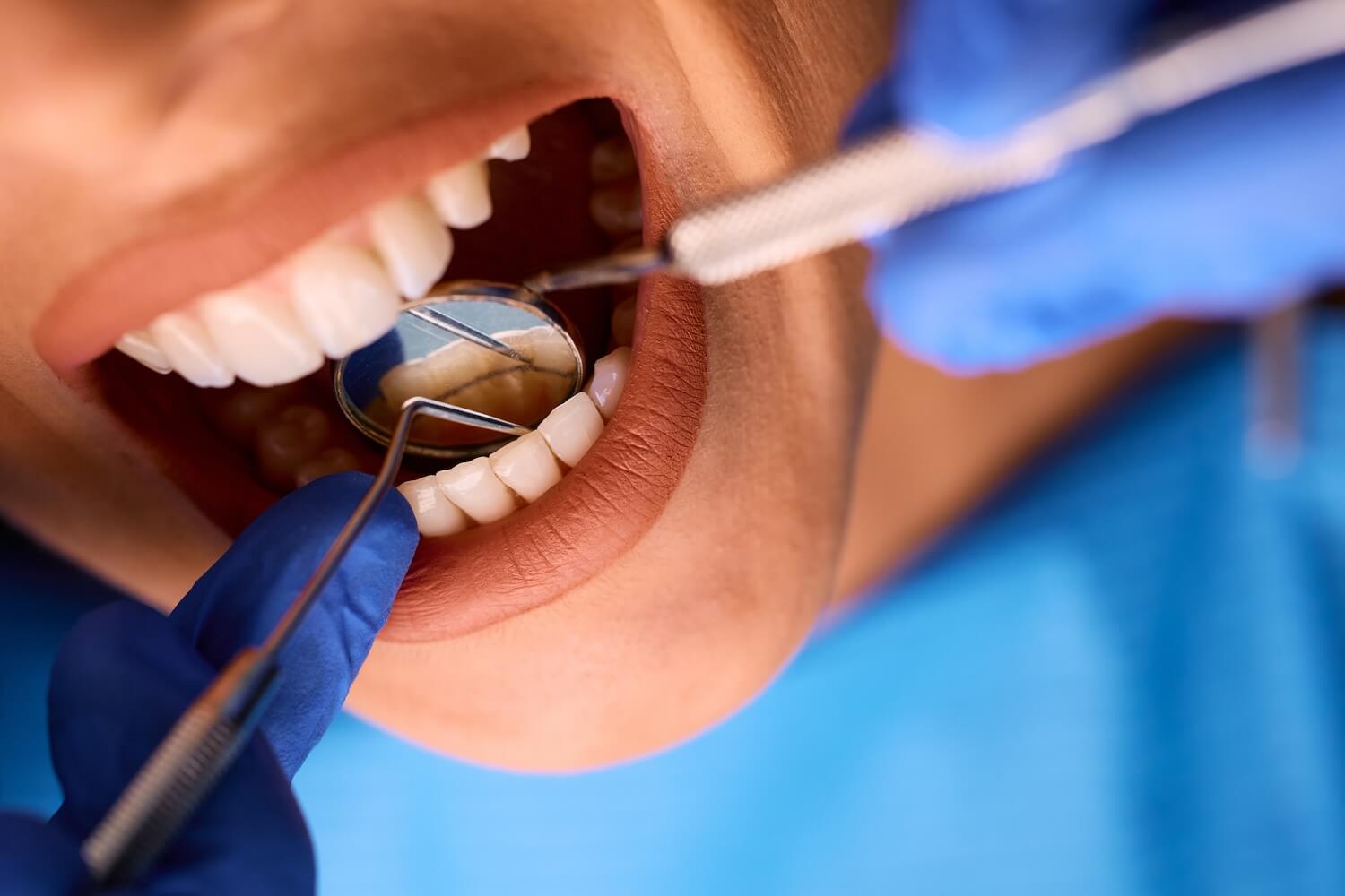 Detailed Guide to Dental Crown Procedure